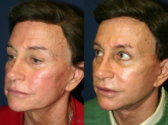 Before & After Facelift Case 8872 View #2 View in Kalamazoo & Grand Rapids, Michigan