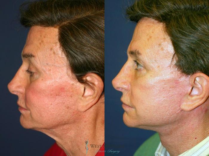 Before & After Facelift Case 8872 View #3 View in Kalamazoo & Grand Rapids, Michigan