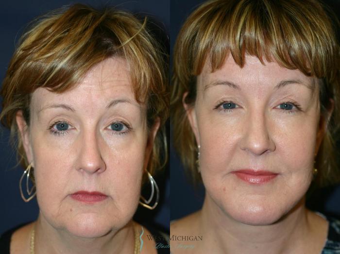 Before & After Chin Augmentation Case 8874 View #1 View in Kalamazoo & Grand Rapids, Michigan