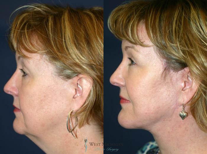 Before & After Chin Augmentation Case 8874 View #2 View in Kalamazoo & Grand Rapids, Michigan