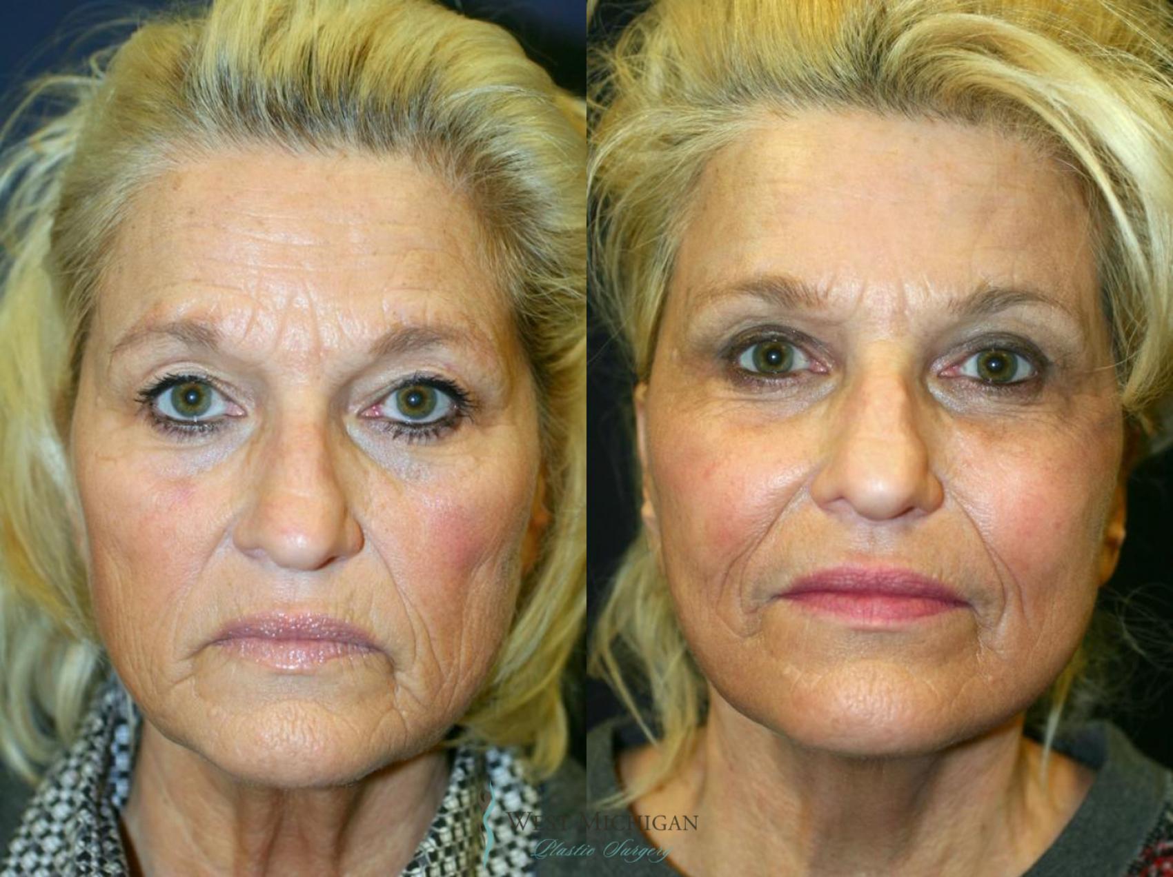 Before & After Facelift Case 8875 View #1 View in Kalamazoo & Grand Rapids, Michigan