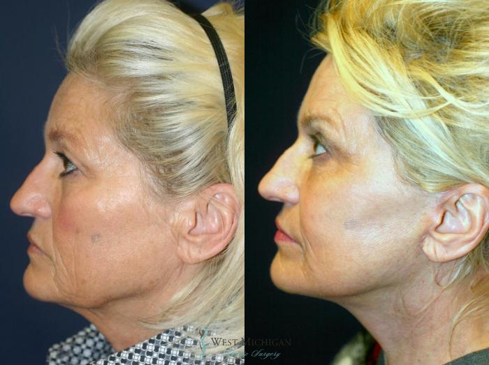 Before & After Facelift Case 8875 View #2 View in Kalamazoo & Grand Rapids, Michigan