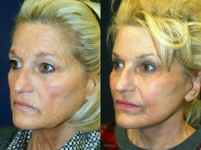 Before & After Facelift Case 8875 View #3 View in Kalamazoo & Grand Rapids, Michigan
