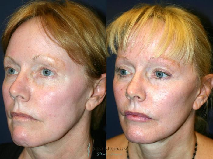 Before & After Facelift Case 8877 View #3 View in Portage, Kalamazoo, Battle Creek, Michigan