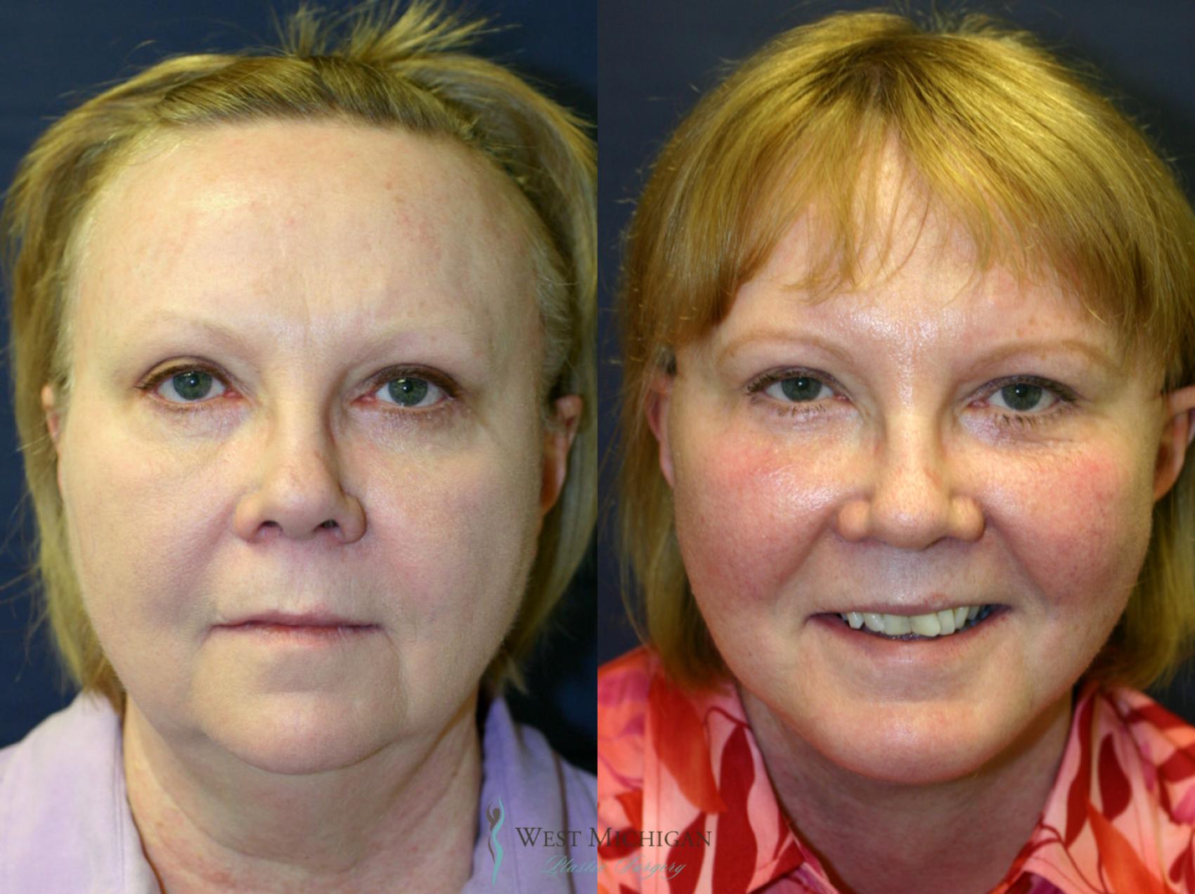 Before & After Facelift Case 8878 View #1 View in Kalamazoo & Grand Rapids, Michigan