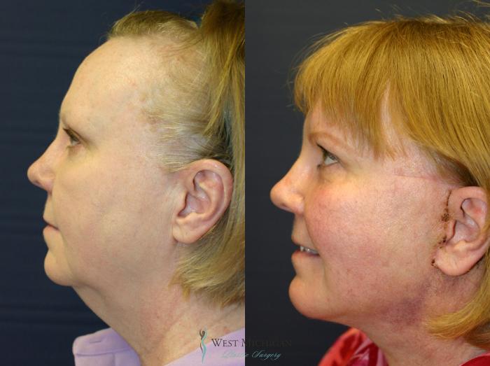 Before & After Facelift Case 8878 View #2 View in Kalamazoo & Grand Rapids, Michigan