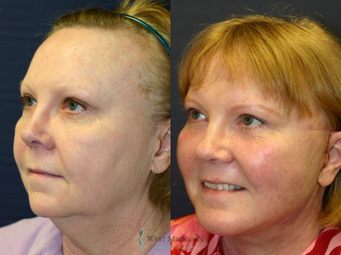 Before & After Facelift Case 8878 View #3 View in Kalamazoo & Grand Rapids, Michigan