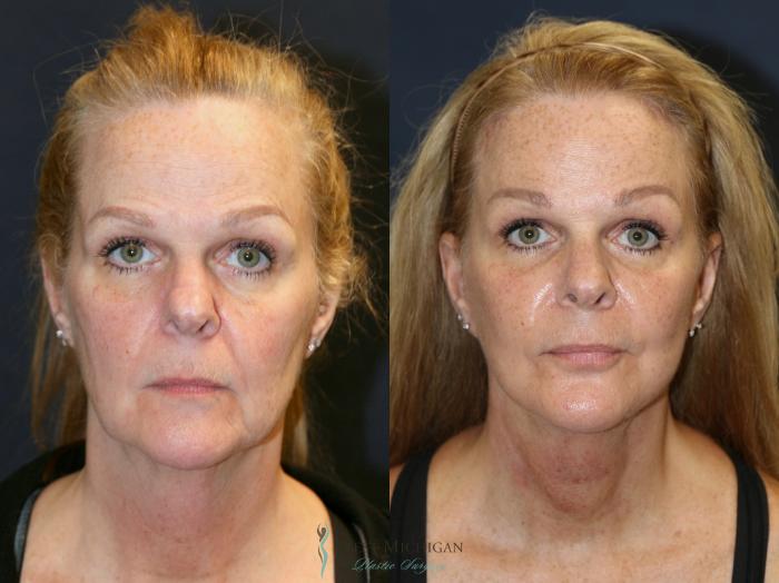 Before & After Brow Lift Case 9323 Front View in Portage, Kalamazoo, Battle Creek, Michigan
