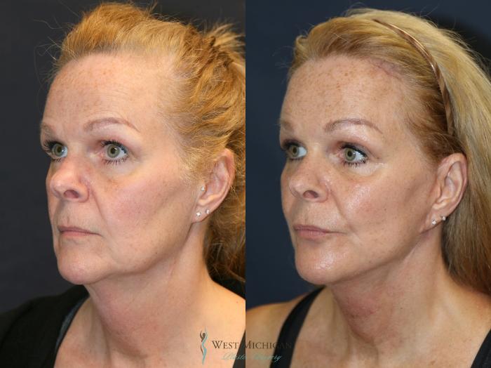 Before & After Brow Lift Case 9323 Left Oblique View in Portage, Kalamazoo, Battle Creek, Michigan