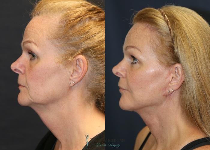 Before & After Facelift Case 9323 Left Side View in Kalamazoo & Grand Rapids, Michigan