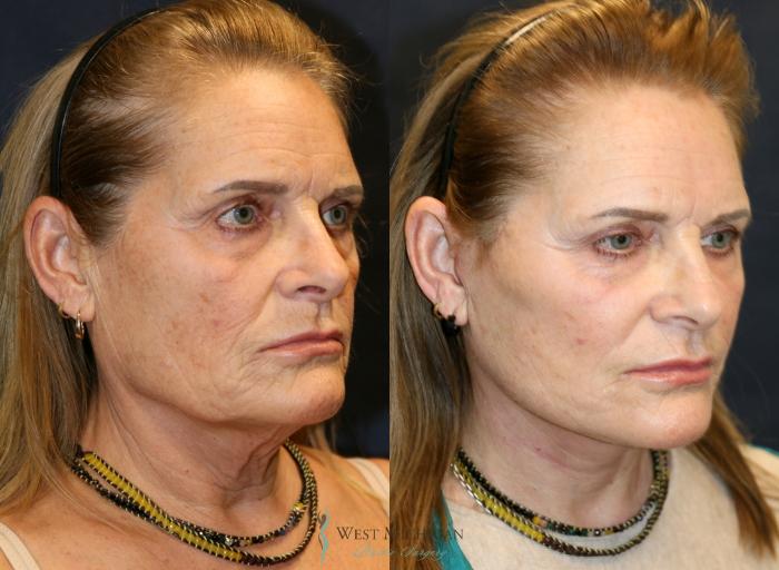 Before & After Facelift Case 9324 Right Oblique View in Portage, Kalamazoo, Battle Creek, Michigan