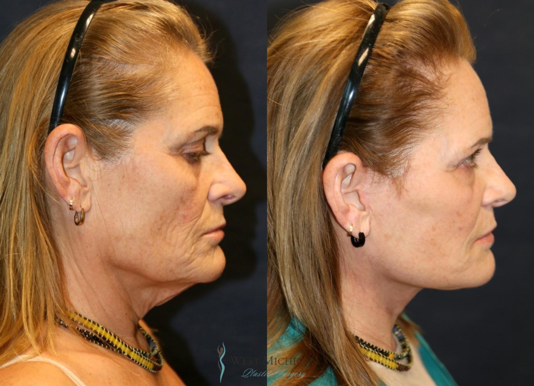 Before & After Facelift Case 9324 Right Side View in Kalamazoo & Grand Rapids, Michigan
