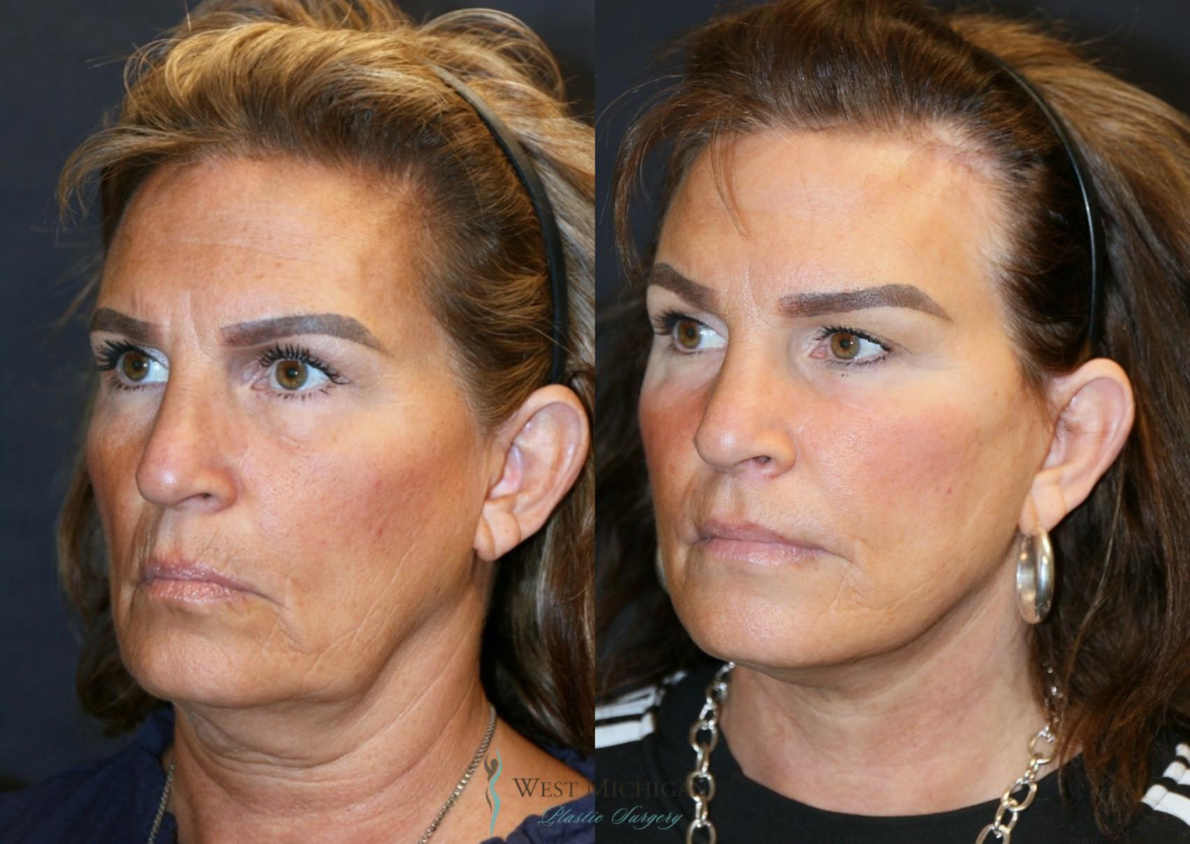 Before & After Facelift Case 9325 Left Oblique View in Kalamazoo & Grand Rapids, Michigan