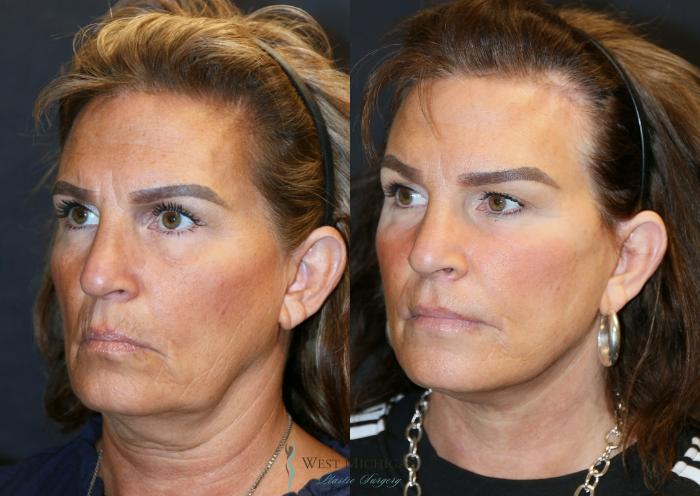 Before & After Brow Lift Case 9325 Left Oblique View in Portage, Kalamazoo, Battle Creek, Michigan