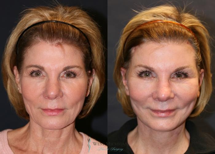 Before & After Brow Lift Case 9350 Front View in Kalamazoo & Grand Rapids, Michigan