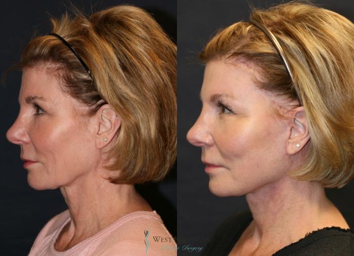 Before & After Brow Lift Case 9350 Left Side View in Kalamazoo & Grand Rapids, Michigan