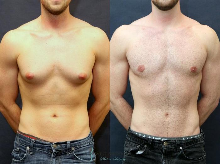 Before & After Gynecomastia Case 8733 View #1 View in Kalamazoo & Grand Rapids, Michigan