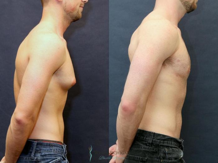 Before & After Gynecomastia Case 8733 View #2 View in Kalamazoo & Grand Rapids, Michigan