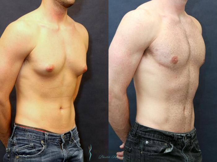 Before & After Gynecomastia Case 8733 View #3 View in Portage, Kalamazoo, Battle Creek, Michigan