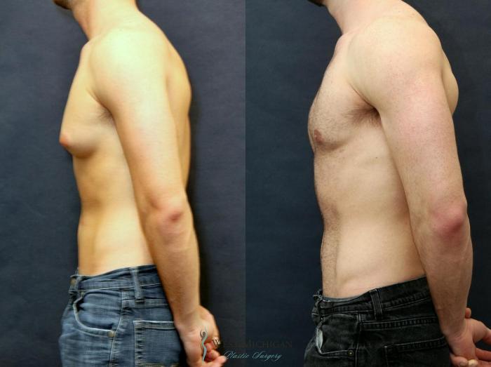 Before & After Gynecomastia Case 8733 View #4 View in Portage, Kalamazoo, Battle Creek, Michigan