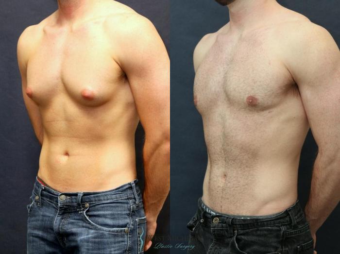 Before & After Gynecomastia Case 8733 View #5 View in Portage, Kalamazoo, Battle Creek, Michigan