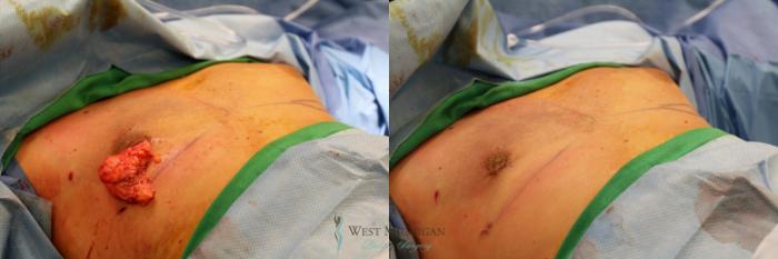 Before & After Gynecomastia Case 8944 Intraoperative View in Kalamazoo & Grand Rapids, Michigan