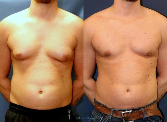 Before & After Gynecomastia Case 8944 View #1 View in Kalamazoo & Grand Rapids, Michigan