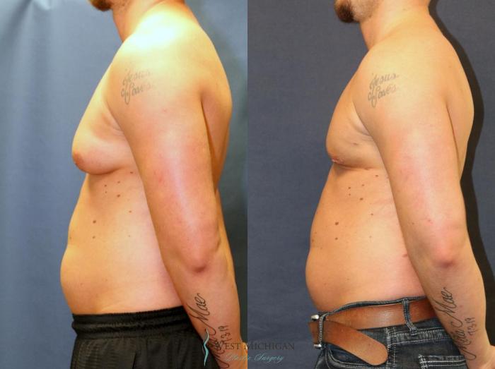 Before & After Gynecomastia Case 8944 View #2 View in Kalamazoo & Grand Rapids, Michigan