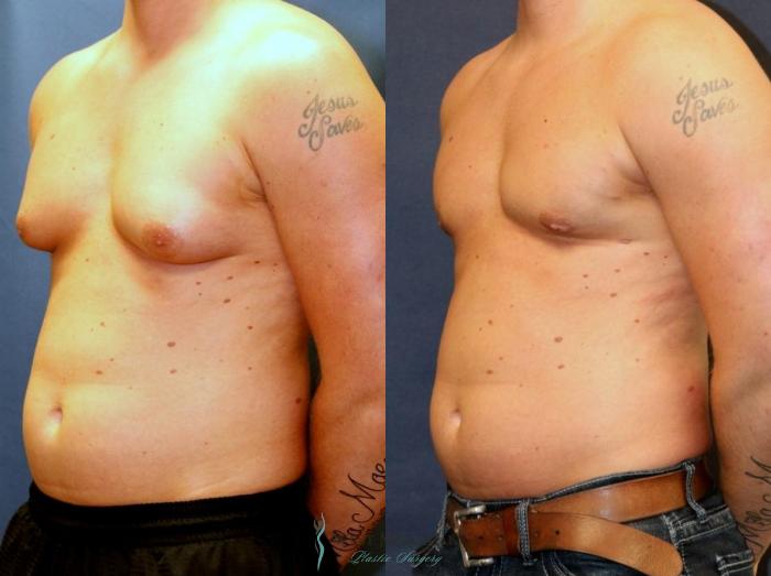Before & After Gynecomastia Case 8944 View #3 View in Kalamazoo & Grand Rapids, Michigan
