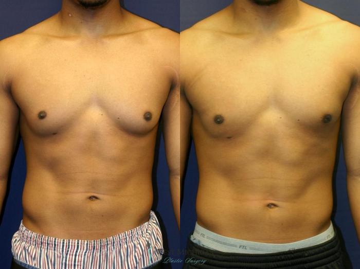 Before & After Gynecomastia Case 8945 View #1 View in Kalamazoo & Grand Rapids, Michigan