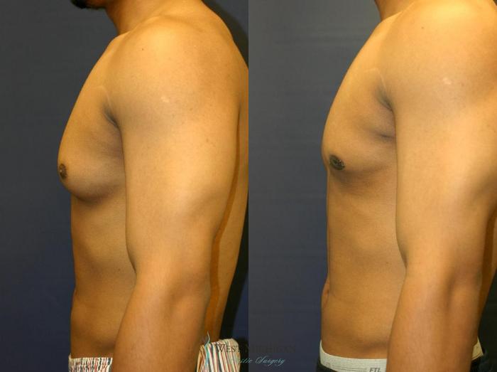 Before & After Gynecomastia Case 8945 View #2 View in Kalamazoo & Grand Rapids, Michigan