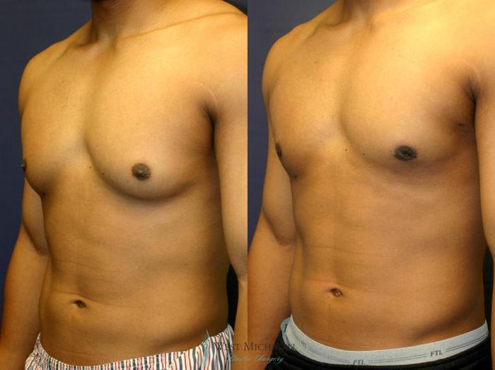 Before & After Gynecomastia Case 8945 View #3 View in Kalamazoo & Grand Rapids, Michigan