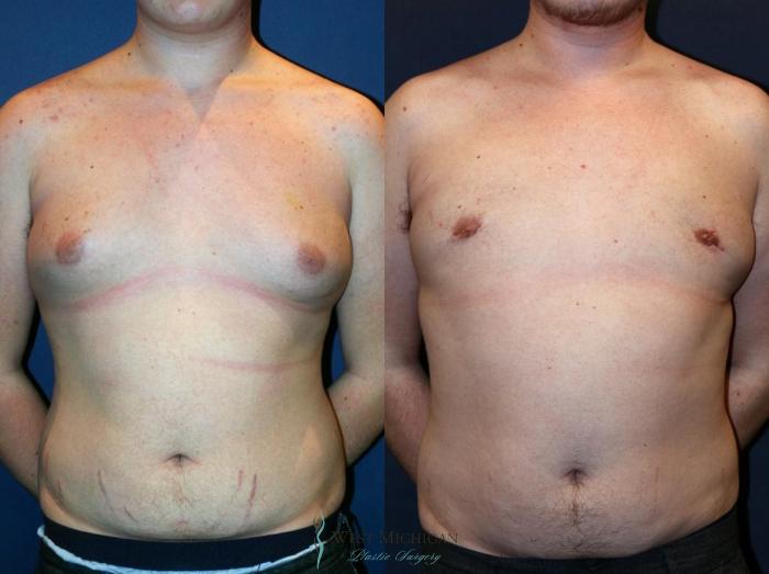 Before & After Gynecomastia Case 9139 View #1 View in Kalamazoo & Grand Rapids, Michigan