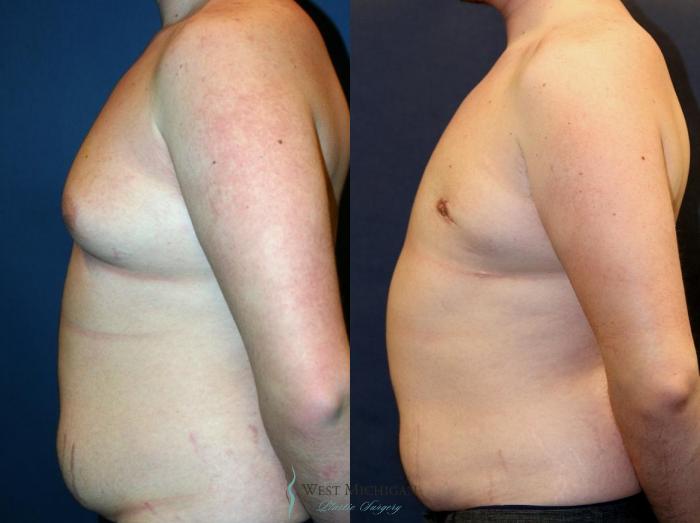 Before & After Gynecomastia Case 9139 View #2 View in Portage, Kalamazoo, Battle Creek, Michigan