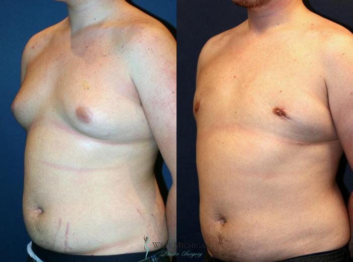 Before & After Gynecomastia Case 9139 View #3 View in Portage, Kalamazoo, Battle Creek, Michigan