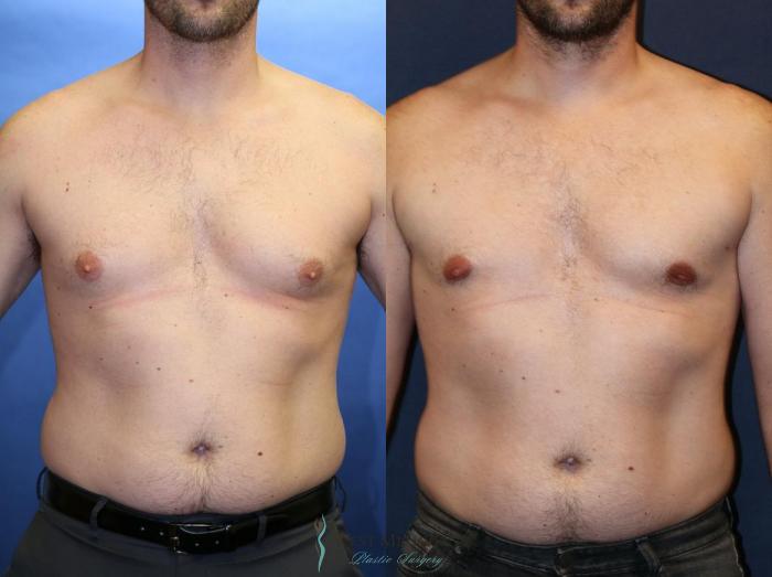 Before & After Gynecomastia Case 9140 View #1 View in Portage, Kalamazoo, Battle Creek, Michigan