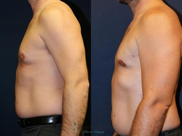 Before & After Gynecomastia Case 9140 View #2 View in Kalamazoo & Grand Rapids, Michigan