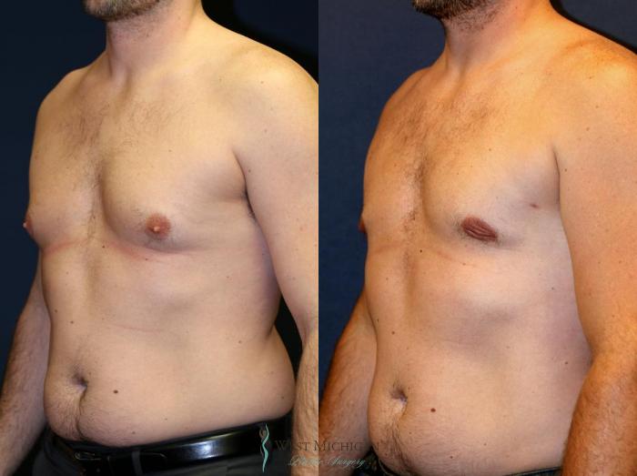 Before & After Gynecomastia Case 9140 View #3 View in Kalamazoo & Grand Rapids, Michigan