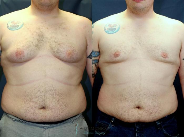 Before & After Gynecomastia Case 9141 View #1 View in Kalamazoo & Grand Rapids, Michigan