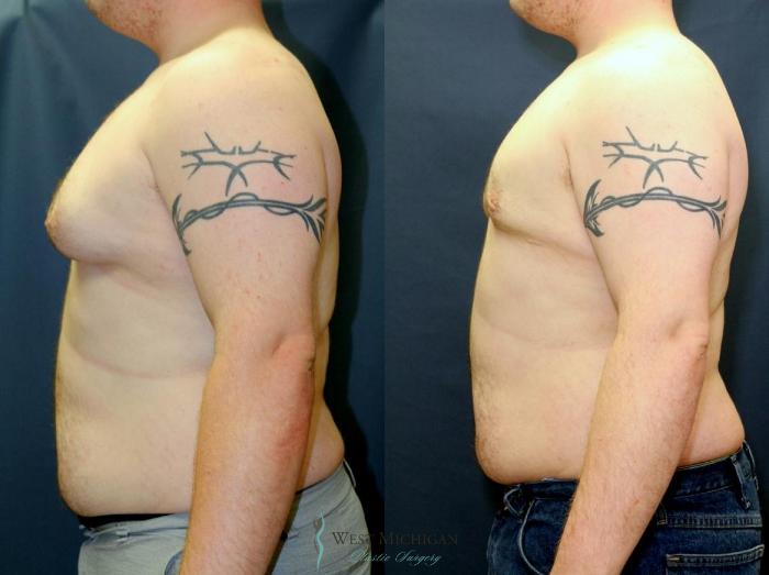 Before & After Gynecomastia Case 9141 View #2 View in Kalamazoo & Grand Rapids, Michigan