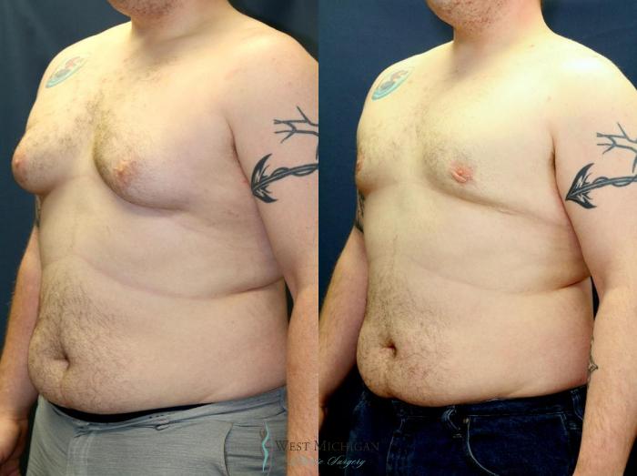 Before & After Gynecomastia Case 9141 View #3 View in Kalamazoo & Grand Rapids, Michigan