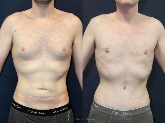 Before & After Gynecomastia Case 9142 View #1 View in Portage, Kalamazoo, Battle Creek, Michigan
