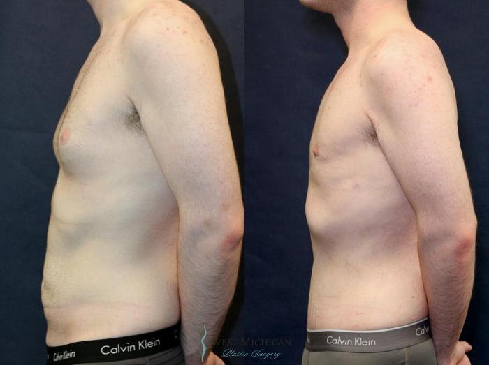 Before & After Gynecomastia Case 9142 View #2 View in Kalamazoo & Grand Rapids, Michigan
