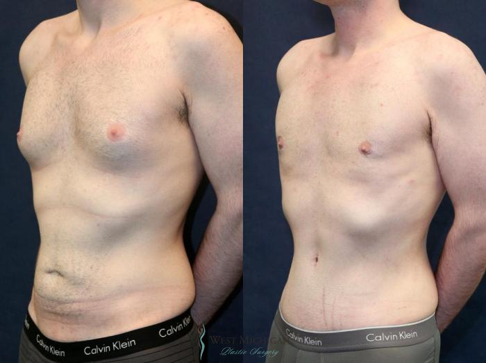 Before & After Gynecomastia Case 9142 View #3 View in Portage, Kalamazoo, Battle Creek, Michigan