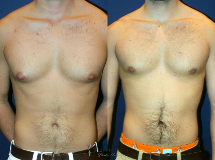 Before & After Gynecomastia Case 9143 View #1 View in Portage, Kalamazoo, Battle Creek, Michigan