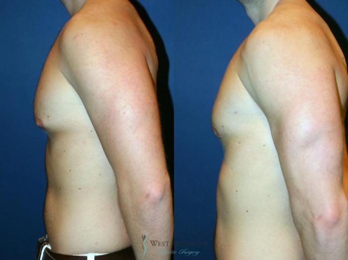 Before & After Gynecomastia Case 9143 View #2 View in Portage, Kalamazoo, Battle Creek, Michigan