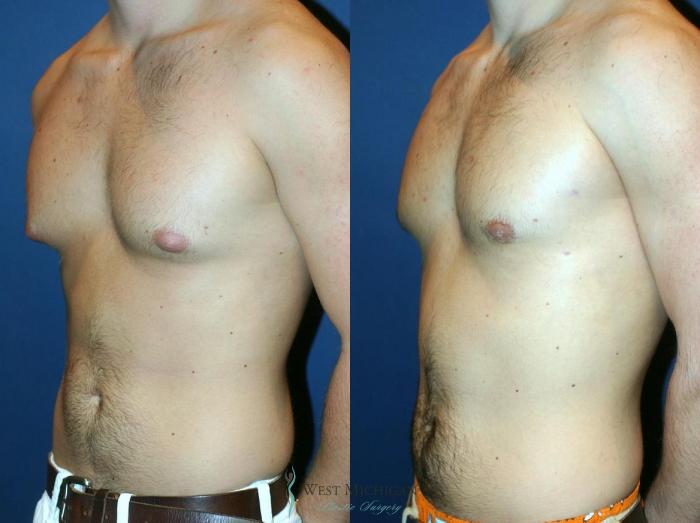 Before & After Gynecomastia Case 9143 View #3 View in Portage, Kalamazoo, Battle Creek, Michigan