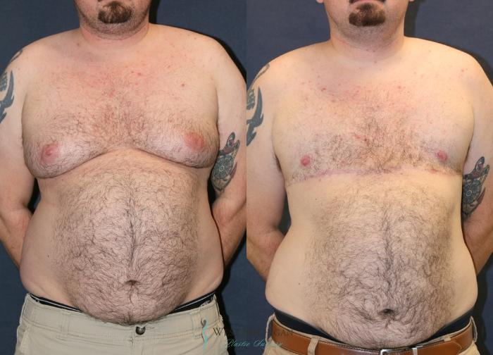 Before & After Gynecomastia Case 9337 Front View in Portage, Kalamazoo, Battle Creek, Michigan