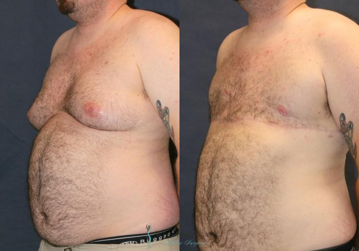 Before & After Gynecomastia Case 9337 Left Oblique View in Kalamazoo & Grand Rapids, Michigan