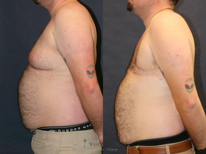 Before & After Gynecomastia Case 9337 Left Side View in Portage, Kalamazoo, Battle Creek, Michigan